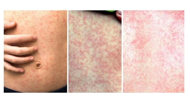 Tìm hiểu kỹ hơn qua hình ảnh của bệnh sởi ở trẻ em thực tế