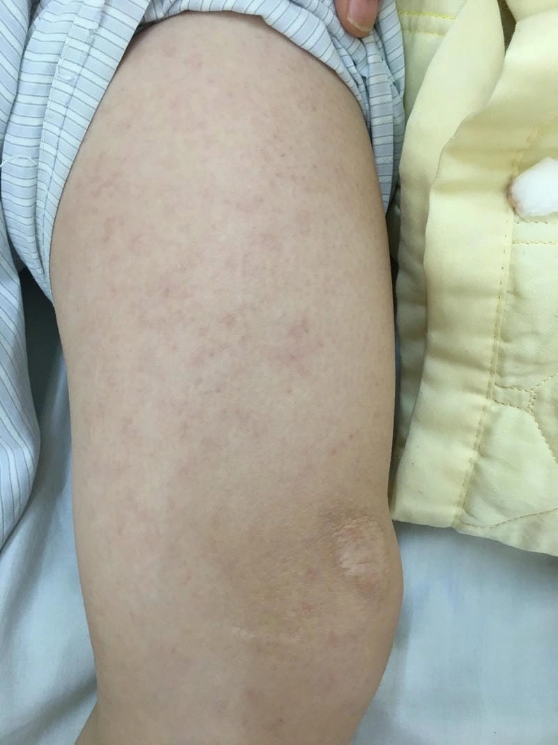 Tham khảo triệu chứng qua ảnh trẻ bị sởi trực quan