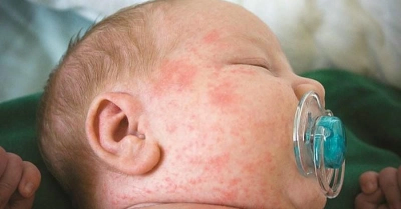 Nhận biết triệu chứng qua hình ảnh bệnh sởi ở trẻ thực tế