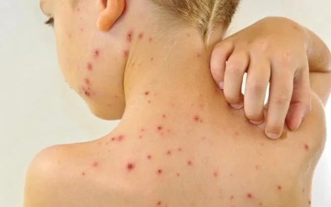 Phân biệt hình ảnh sởi nhẹ ở trẻ em với phát ban thông thường