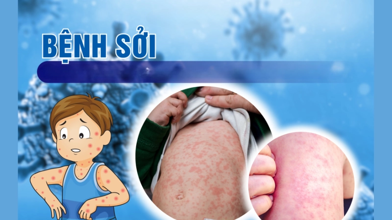 Hình ảnh bệnh sởi trẻ em là như thế nào