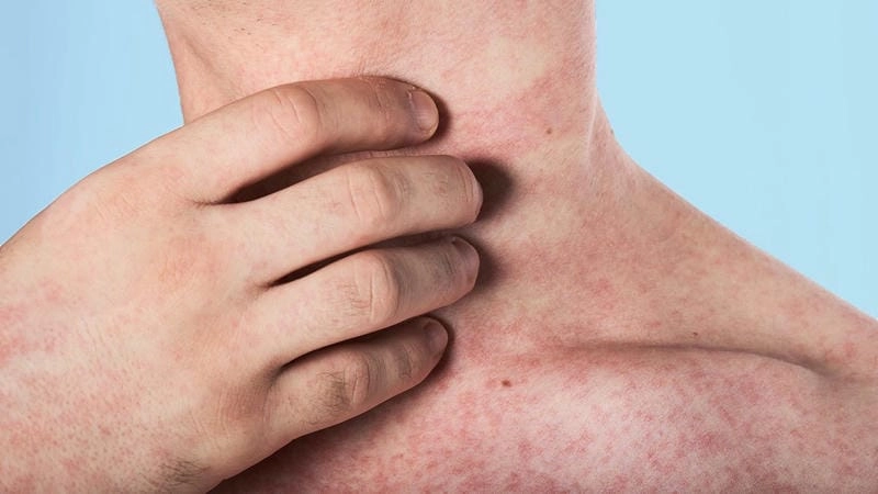 Tổng hợp ảnh bệnh sởi dễ nhận biết