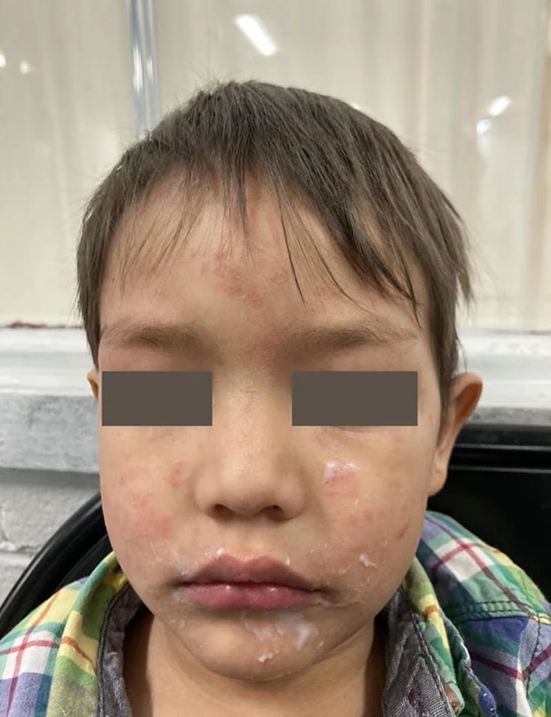 So sánh hình ảnh sởi và phát ban thường gặp