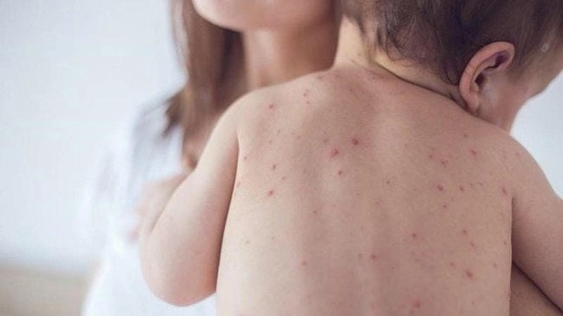 Tìm hiểu hình ảnh của bệnh sởi ở trẻ em
