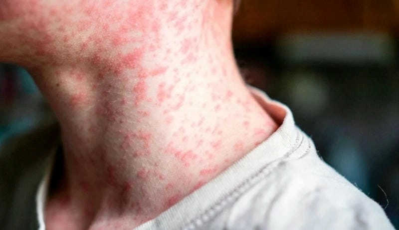 Phân biệt hình ảnh bệnh sởi ở người lớn