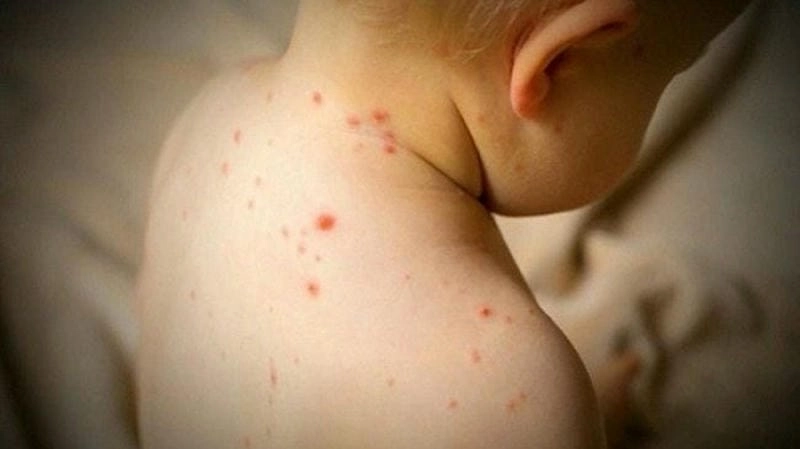 Nhận diện hình ảnh bệnh sởi trẻ em chính xác