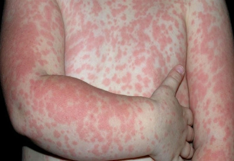 Xem rõ hình ảnh bệnh sởi trẻ em để kịp thời xử lý