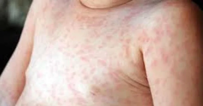 Dấu hiệu cảnh báo qua hình ảnh lên sởi ban đầu