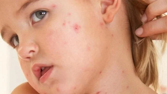 Cập nhật chi tiết hình ảnh sởi ở trẻ em qua từng giai đoạn