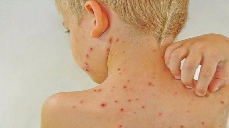 Bệnh sốt siêu vi thường gặp ở trẻ nhỏ