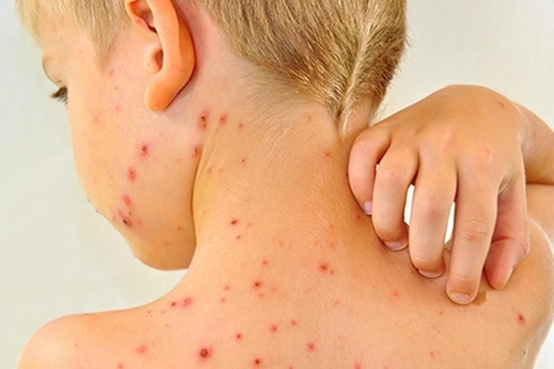 Ảnh muỗi sốt xuất huyết là nguồn lây truyền chính của bệnh