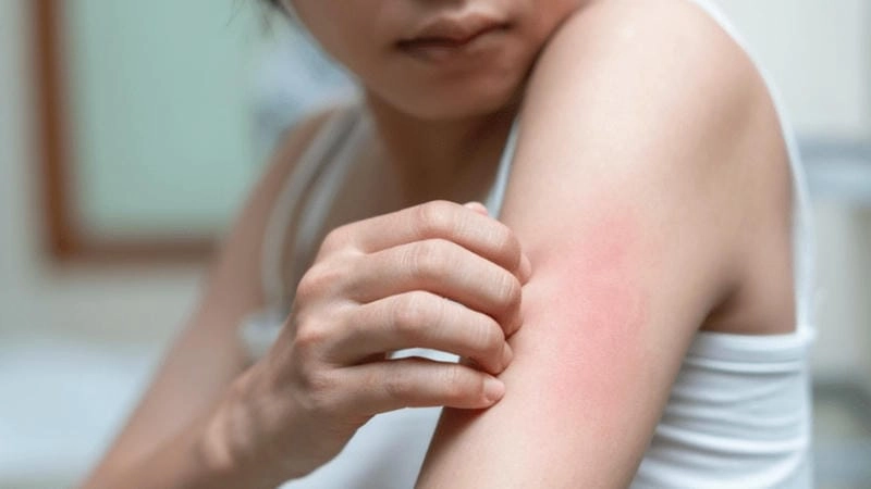 Hình ảnh nốt xuất huyết dưới da là biểu hiện sớm dễ nhận thấy