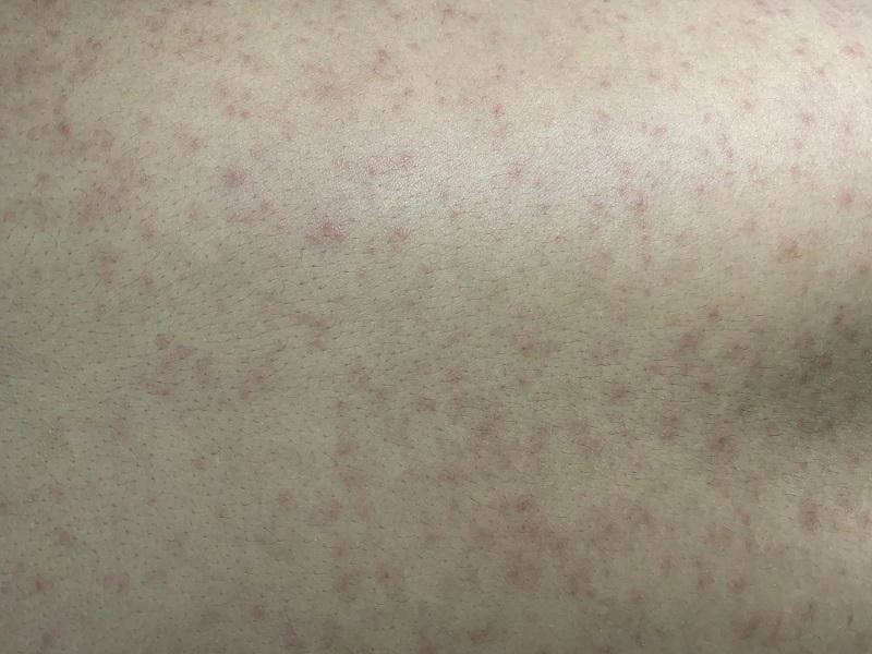 Hình ảnh sốt xuất huyết dưới da thể hiện các vết xuất huyết nhỏ