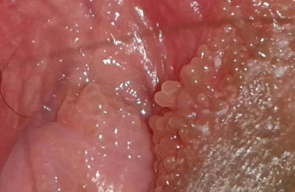 Hình ảnh bệnh sùi mào gà ở người trẻ tăng cao do thiếu kiến thức