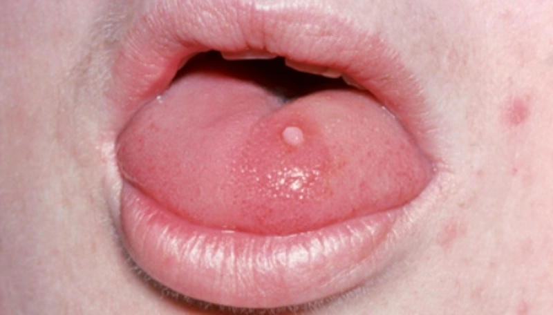 Hình ảnh bệnh sùi mào gà ở nam thường gặp