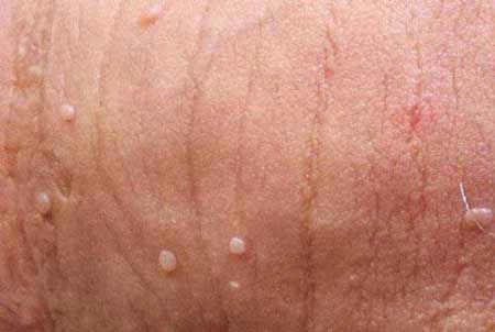 Hình ảnh bệnh sùi mào gà ở nam giới giai đoạn đầu