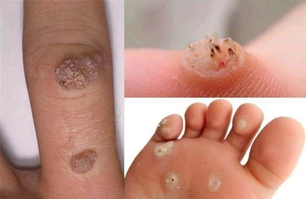 Bệnh sùi mào gà ở nữ hình ảnh cảnh báo dấu hiệu đầu tiên