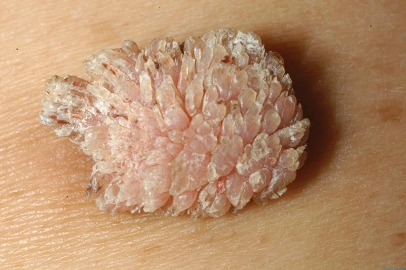 Hình ảnh bệnh sùi mào gà giai đoạn đầu điển hình