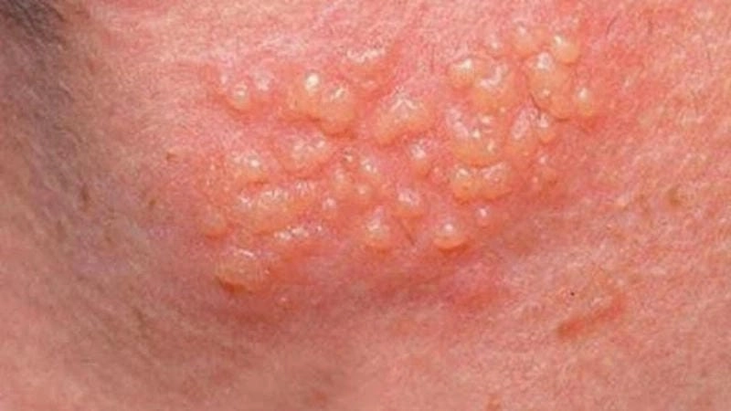 Xem rõ hình ảnh bệnh sùi mào gà thể nhẹ