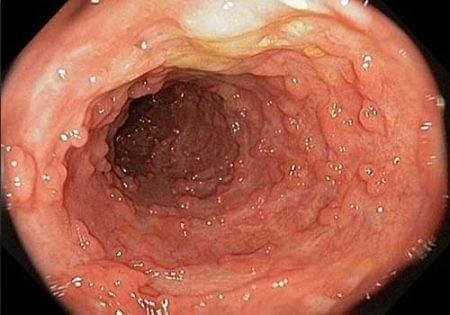 Tham khảo hình ảnh bệnh sùi mào gà ở nữ
