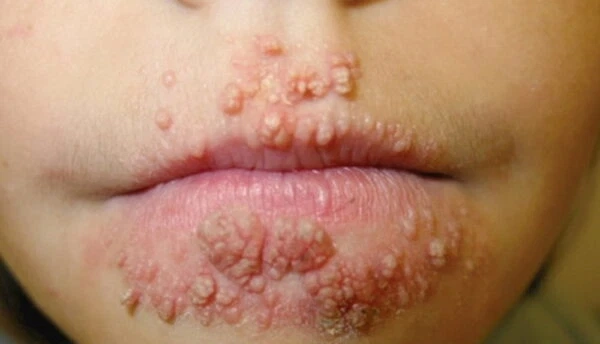 Hình ảnh bệnh sùi mào gà ở miệng có thật