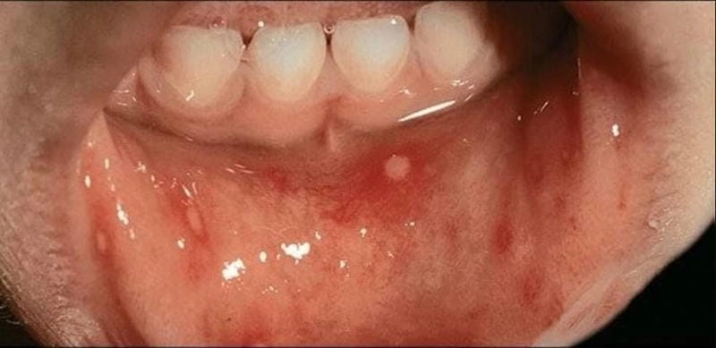 Chẩn đoán qua hình ảnh bệnh tay chân miệng ở trẻ em giai đoạn đầu