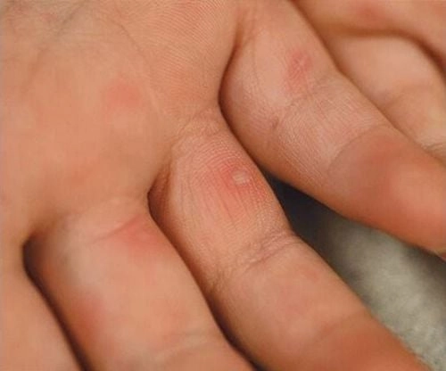 Xem kỹ hình ảnh bị bệnh tay chân miệng để tránh nhầm lẫn