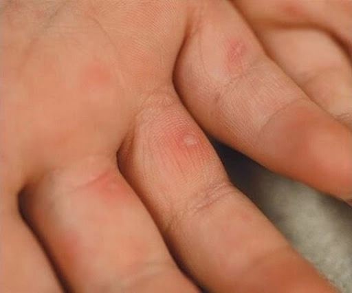 Hình ảnh bé bị tay chân miệng thường nổi bóng nước nhỏ