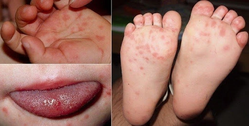 Tăng hiểu biết từ hình ảnh phòng chống bệnh tay chân miệng