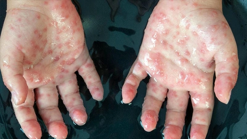 Nhận diện sớm hình ảnh bệnh dấu hiệu tay chân miệng nhẹ