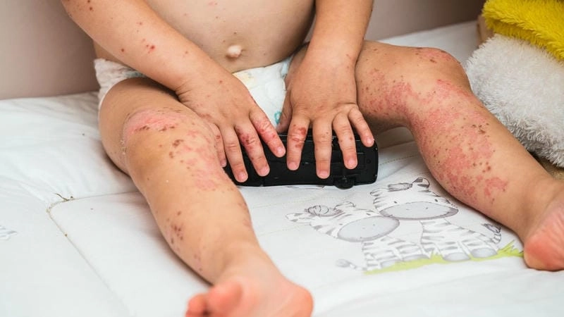 Tổng hợp chuẩn y khoa ảnh bệnh chân tay miệng