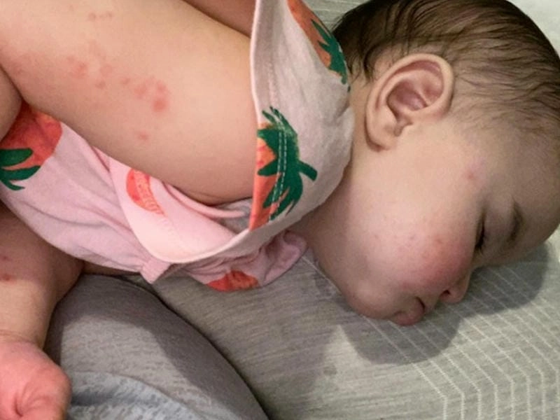 Dễ hiểu với loạt ảnh bệnh tay chân miệng