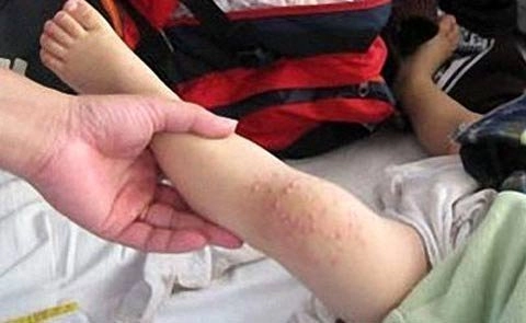 Cùng xem hình ảnh bị bệnh tay chân miệng để biết dấu hiệu rõ hơn