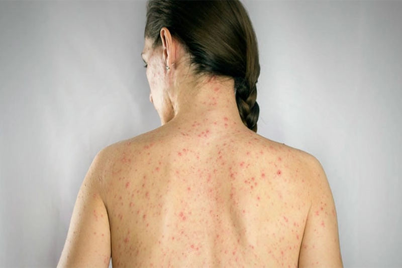 Hình ảnh bị trái rạ thường xuất hiện ở vùng bụng và lưng