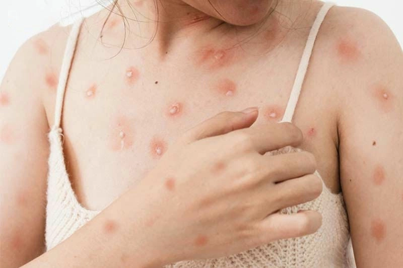 Hình ảnh bệnh thuỷ đậu giúp nhận biết triệu chứng ban đầu