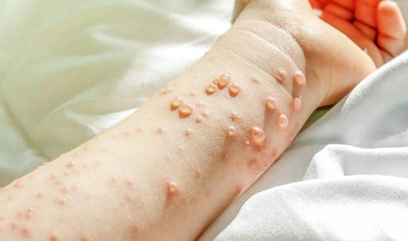 Hình ảnh bệnh trái rạ tương tự với các nốt đỏ li ti