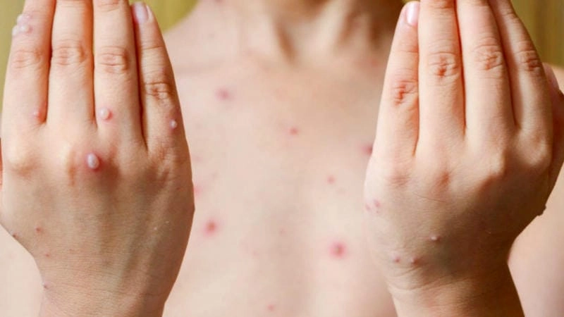 Hình ảnh thủy đậu ở người lớn thường lan nhanh khắp cơ thể