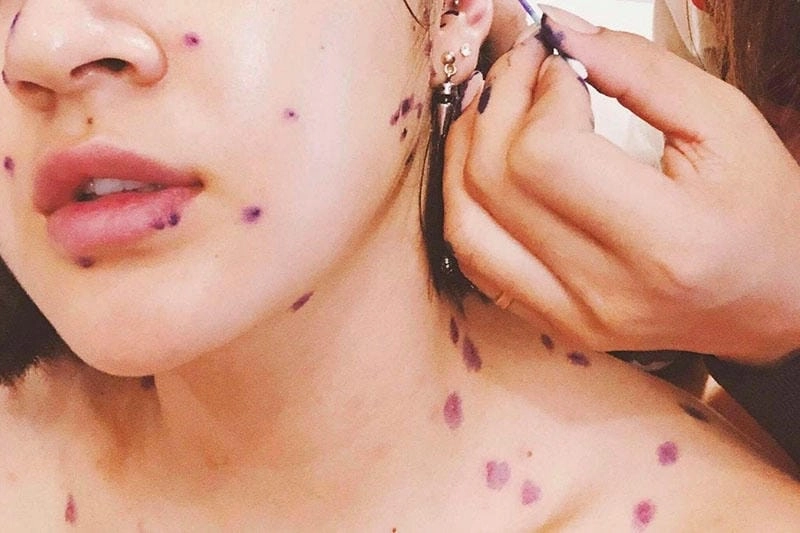 Hình ảnh bị thuỷ đậu ở trẻ em có thể nhẹ hơn người lớn