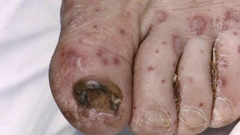 Hình ảnh bé bị thủy đậu thường kèm sốt nhẹ và ngứa