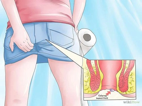 Hình ảnh bệnh nhân trĩ ngoại nhẹ cho thấy mức độ tổn thương