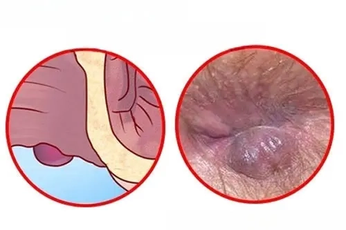 Hình ảnh bệnh hình ảnh bệnh trĩ nội khó phát hiện sớm
