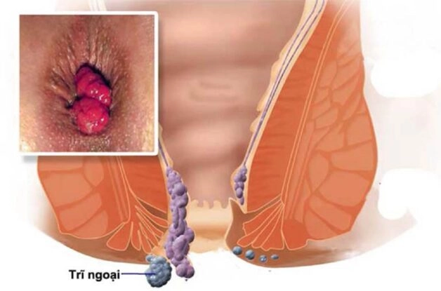 Hình ảnh bệnh trĩ ở nam giới có đặc điểm riêng biệt