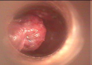 Hình ảnh người bị bệnh trĩ giúp nhận diện tình trạng