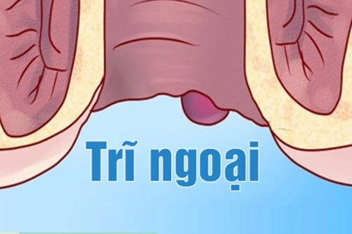 Hình ảnh bệnh trĩ nhẹ thường không gây đau nhiều