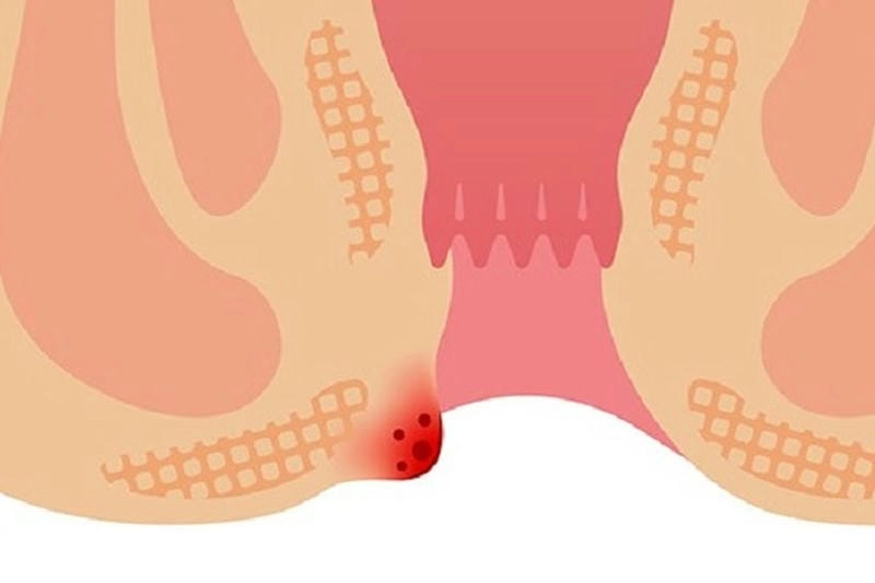 Hình ảnh bệnh hình ảnh bệnh trĩ ngoại nhẹ dễ nhầm lẫn