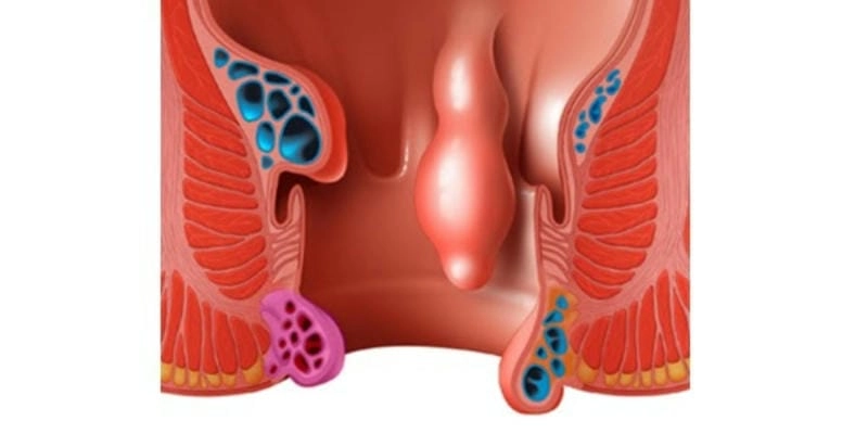 Hình ảnh bệnh trĩ ngoại độ 1 nhận biết bằng mắt thường