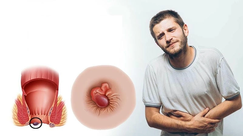 Hình ảnh bệnh trĩ ngoại nhẹ thường khó nhận biết