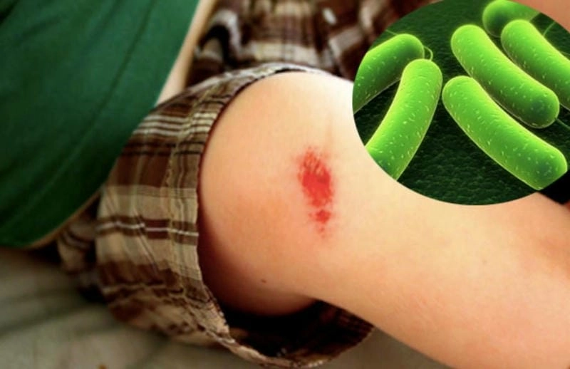 Hình ảnh bệnh uốn ván ở trẻ em và người lớn