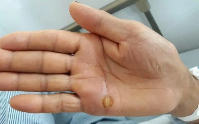 Cập nhật dấu hiệu nhận biết uốn ván phổ biến