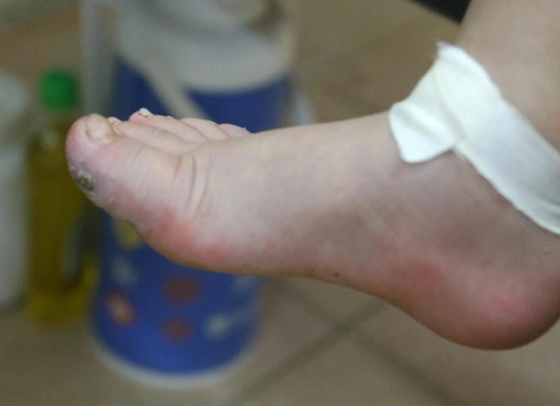 Giải thích chi tiết uốn ván bệnh học bằng hình ảnh